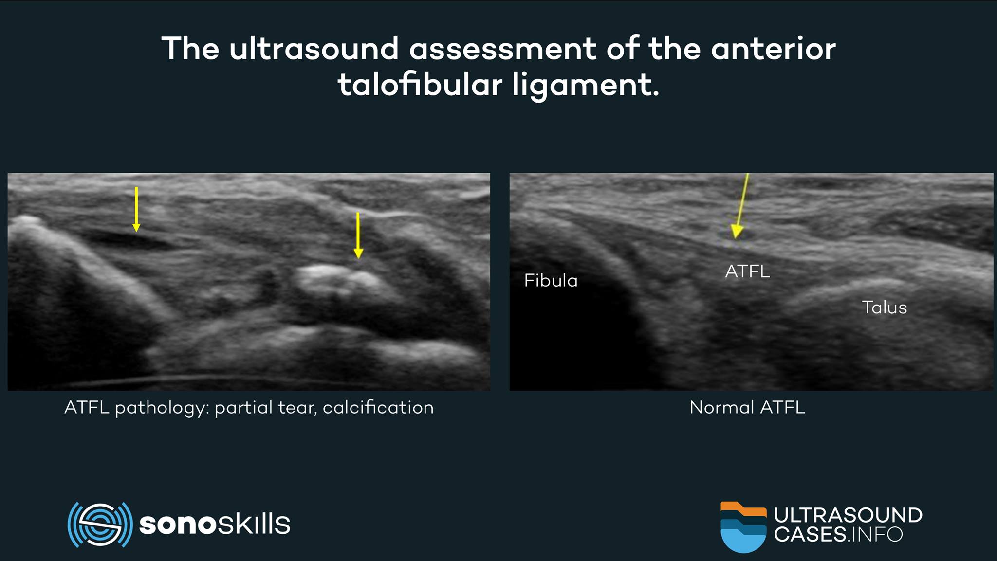 Marc - The anterior talofibular ligament (ATFL) is being affected in 65 ...
