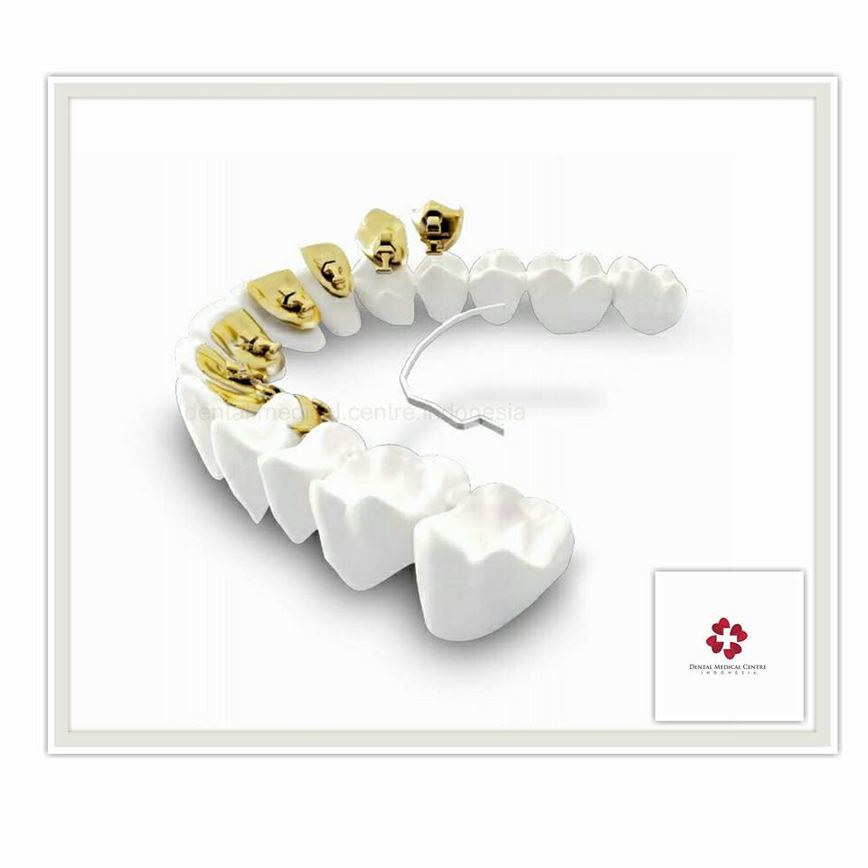 Dental Medical Centre Indonesia - 3M™ ESPE™ Filtek™ P60 Posterior ...
