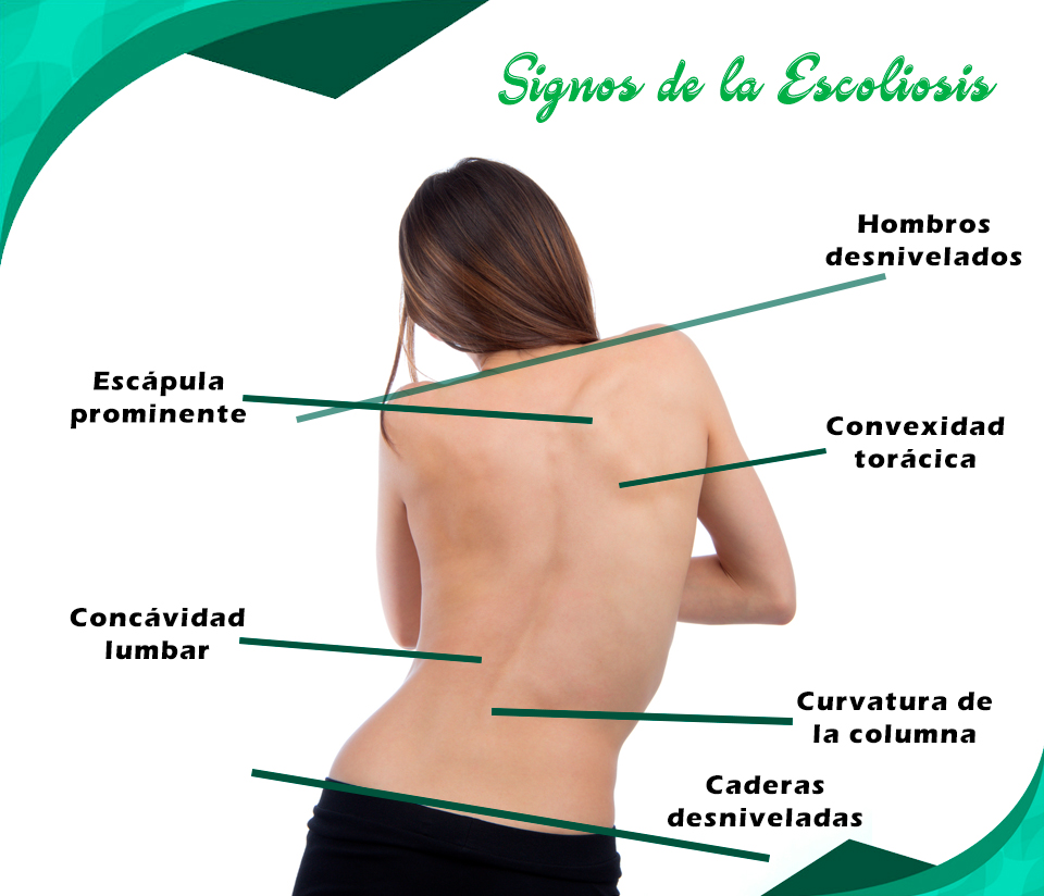 #Escoliosis... - Centro Quiropractico Stumvoll Sede San Borja