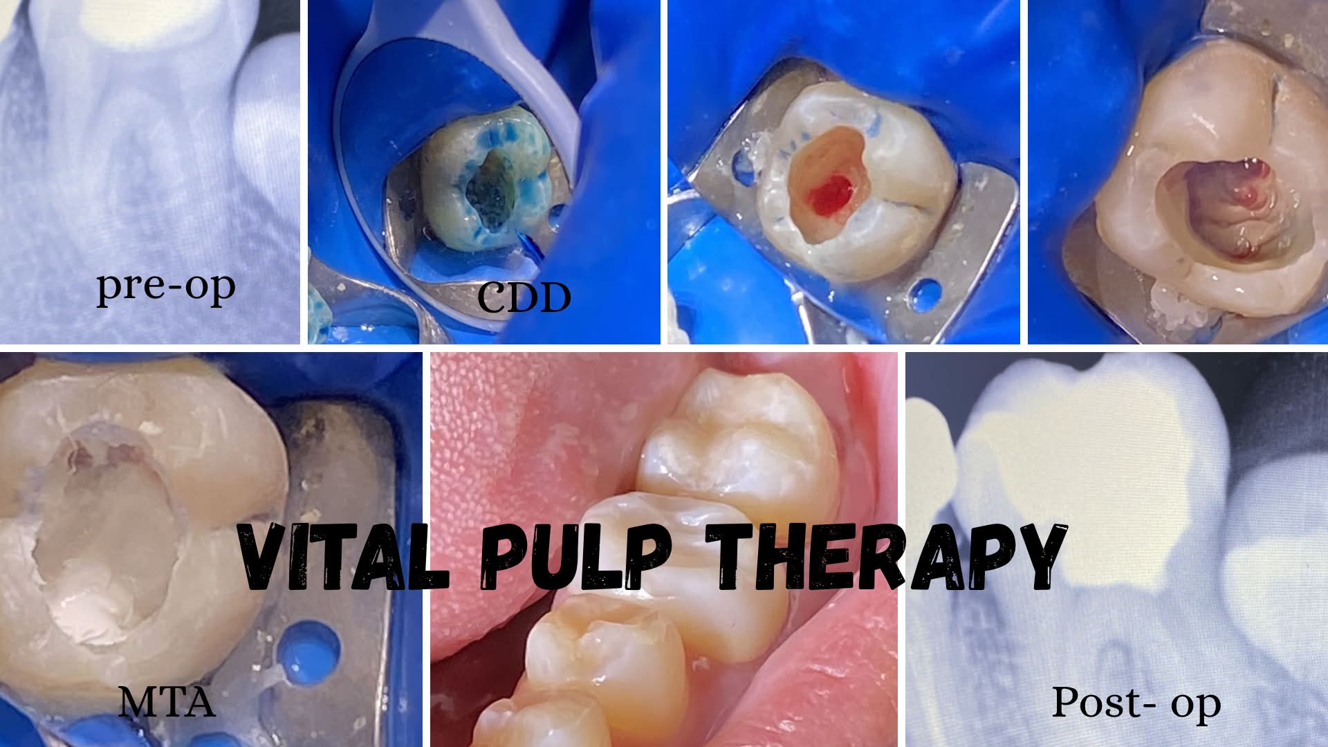 Vital pulp therapy procedure for adult patient