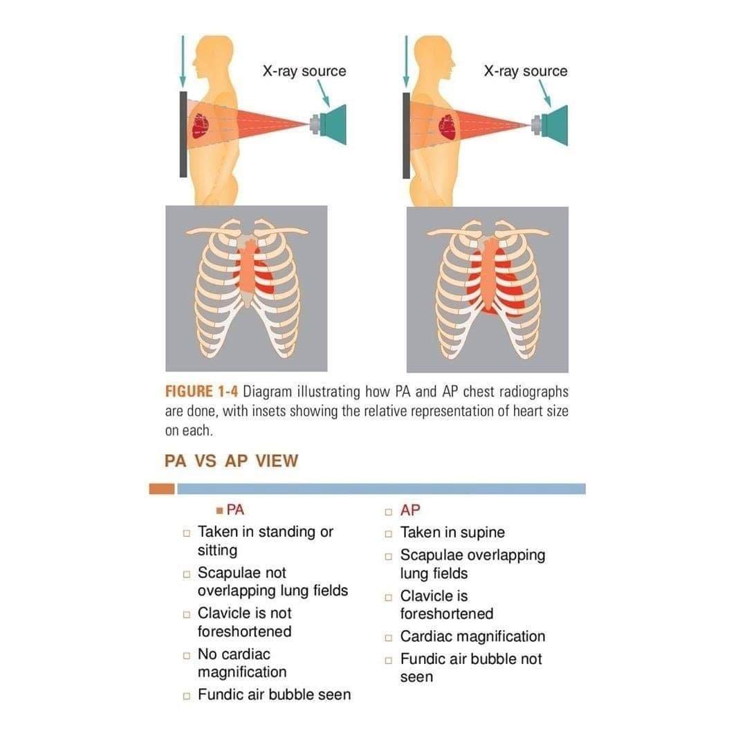 Xray Department - different between AP and PA Chest x ray | Facebook