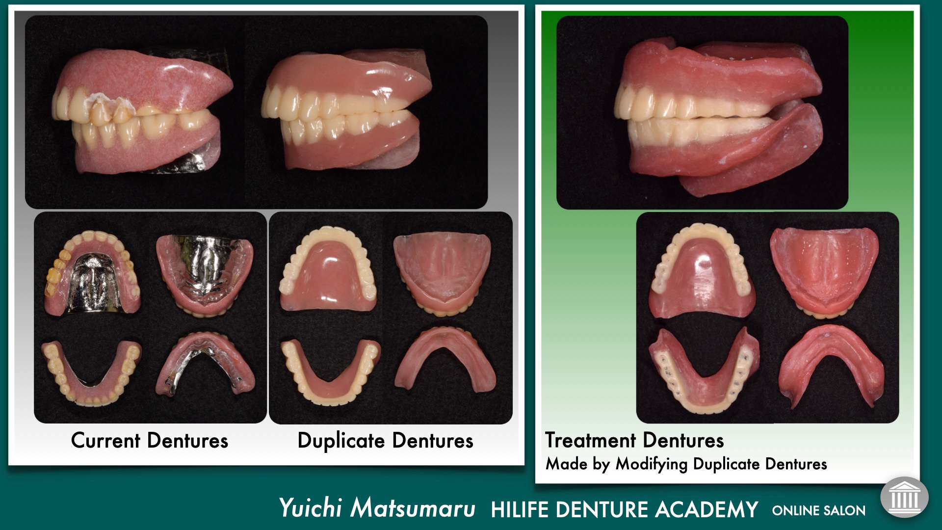 Complete dentures fabrication techniques in Japan
