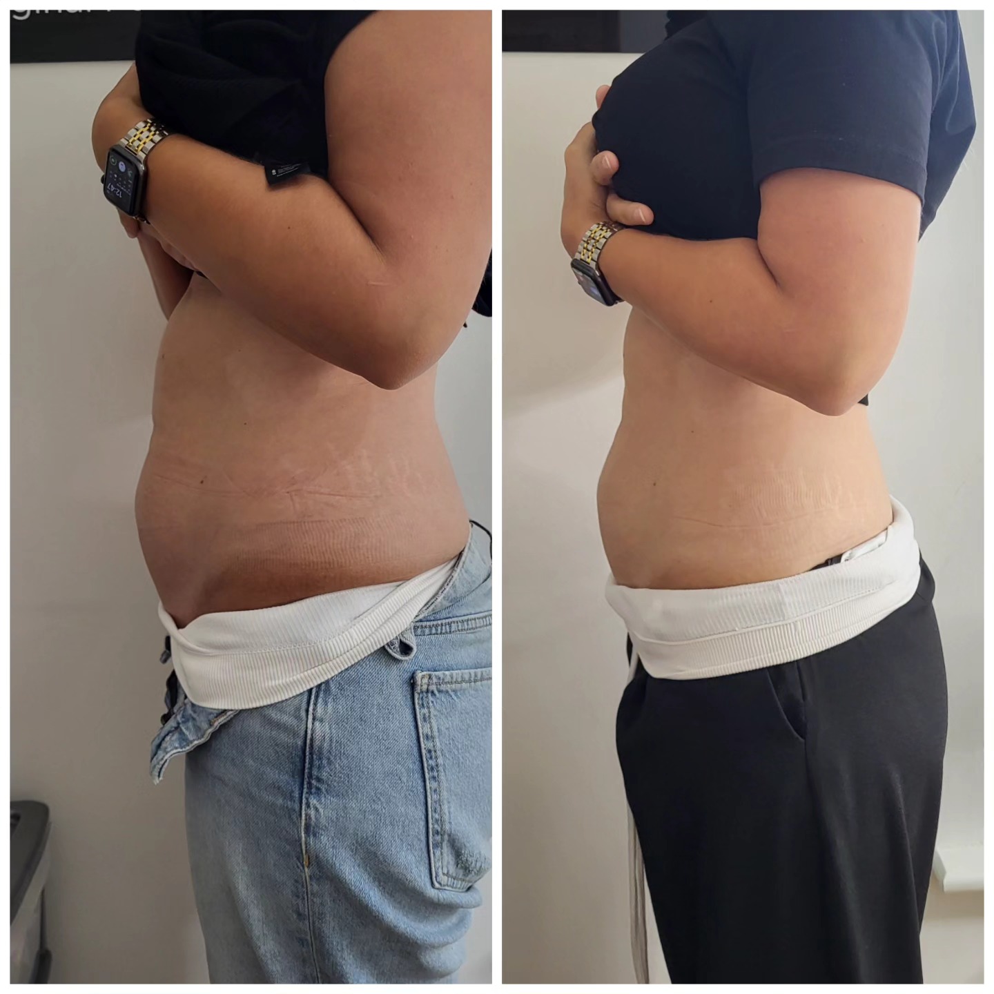 lemon bottle fat dissolving edinburgh 🍋 This treatment is so popular right now! The results speak for themselves. My client has lost inches around her tummy area and is over the moon with the results Natural Aroma Flavour:Classic Rose L-Carnitine Injection — 30-Day