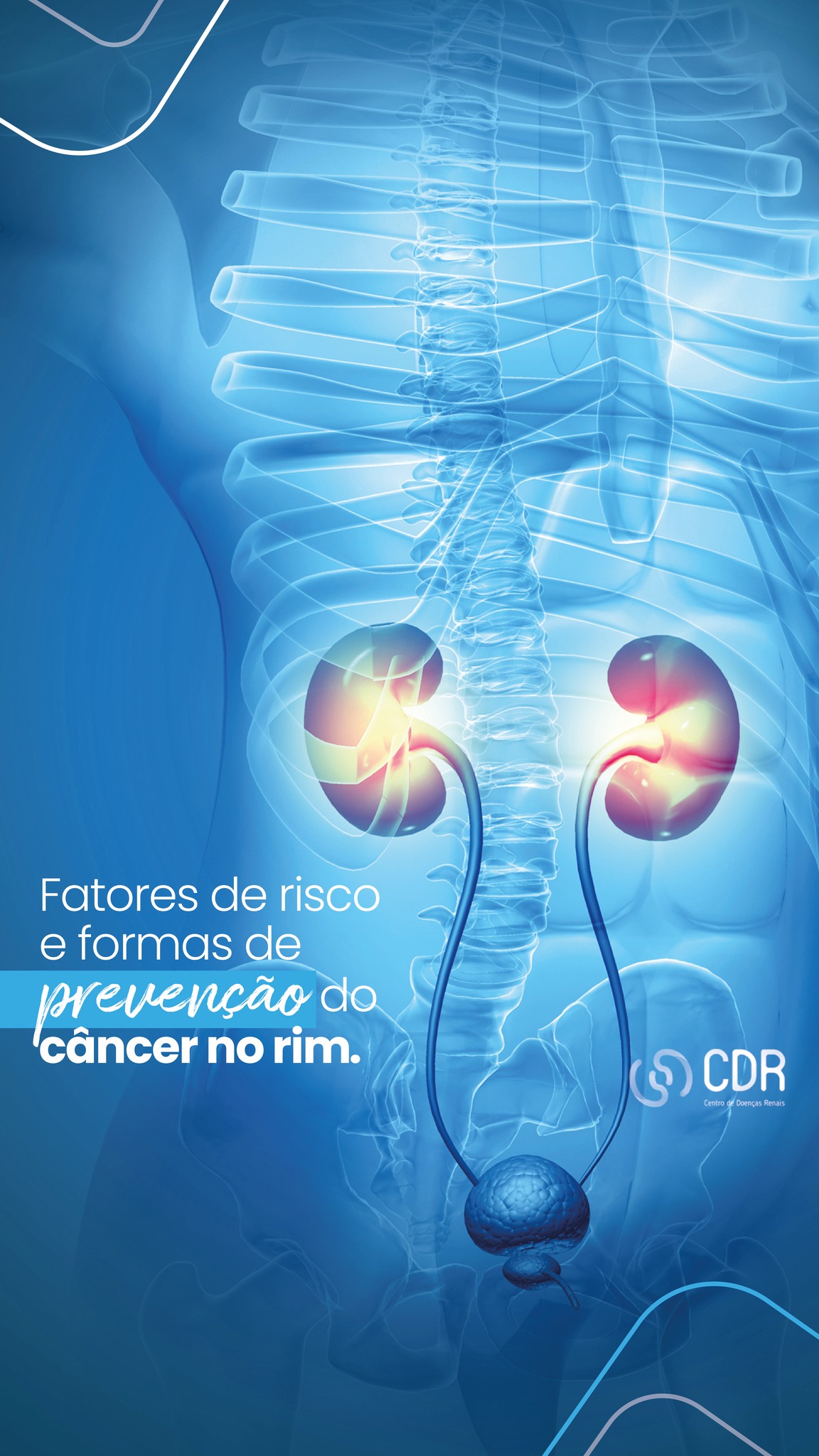 O câncer de rim é... - Centro de Doenças Renais do AM - CDR