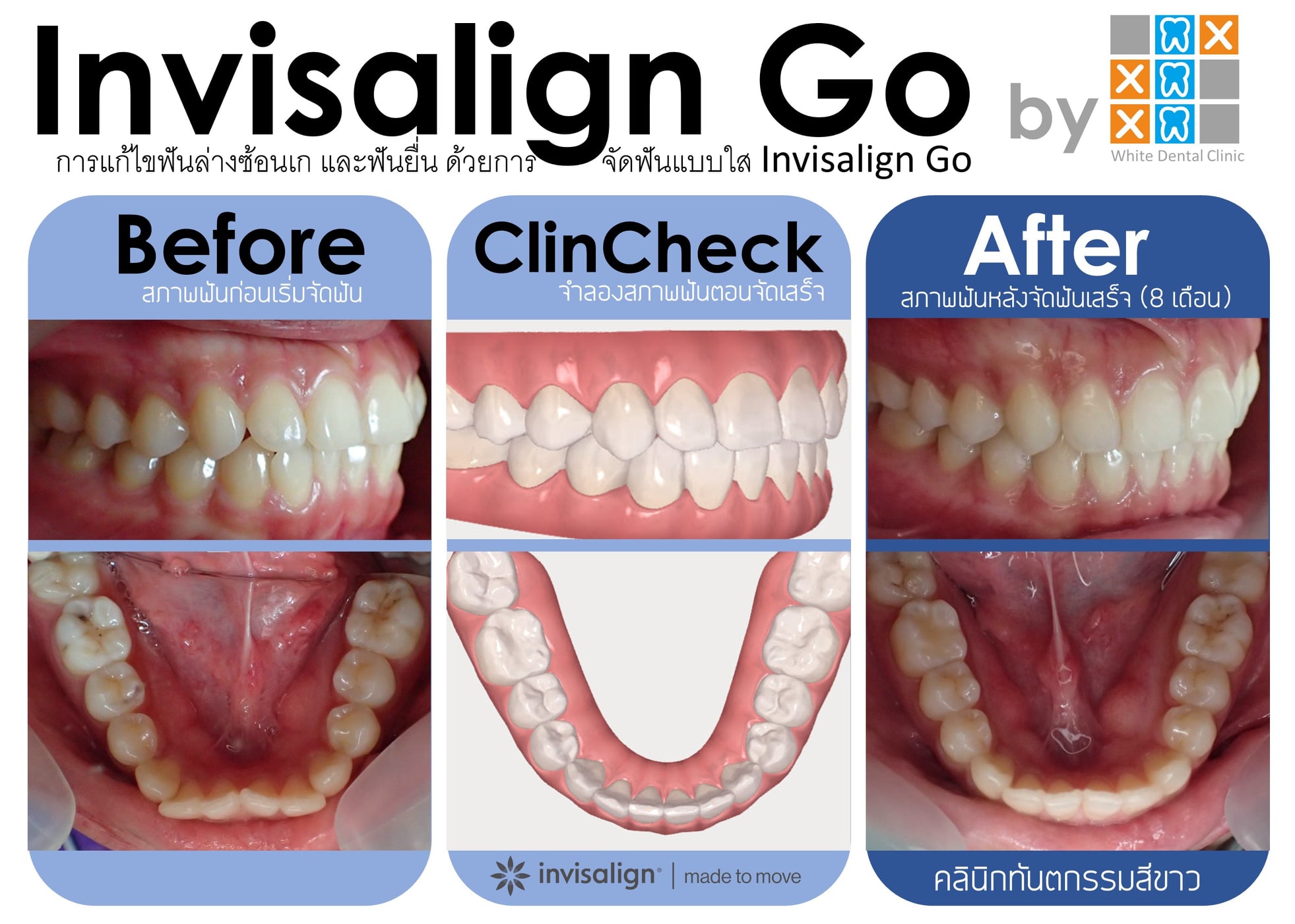 WDC | Invisalign GO... - คลินิกทันตกรรมสีขาว | Facebook