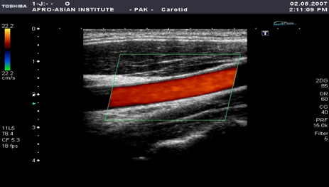 Carotid Pseudo String... - USC SOM Ultrasound Interest Group