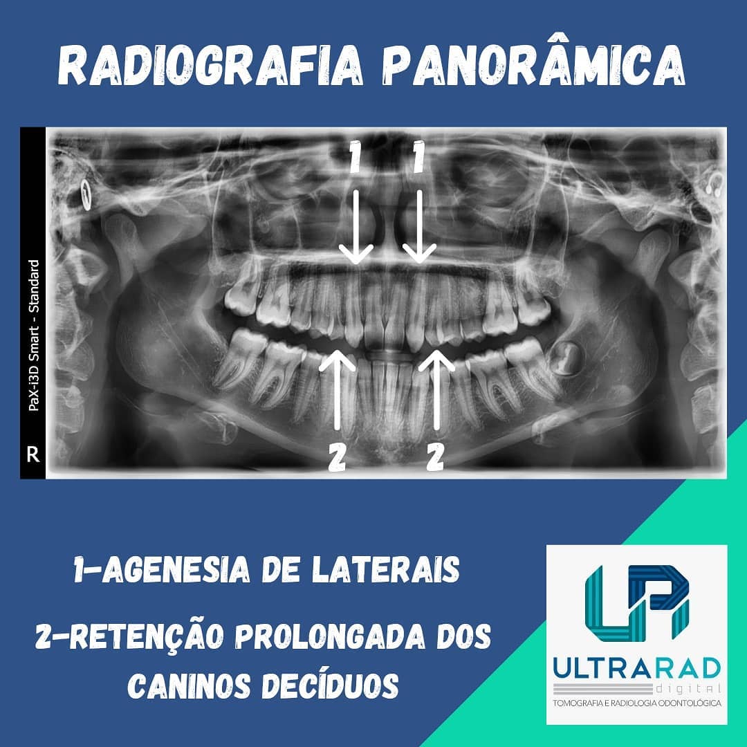 AGENESIA... - Ultrarad - Radiologia Odontológica Digital