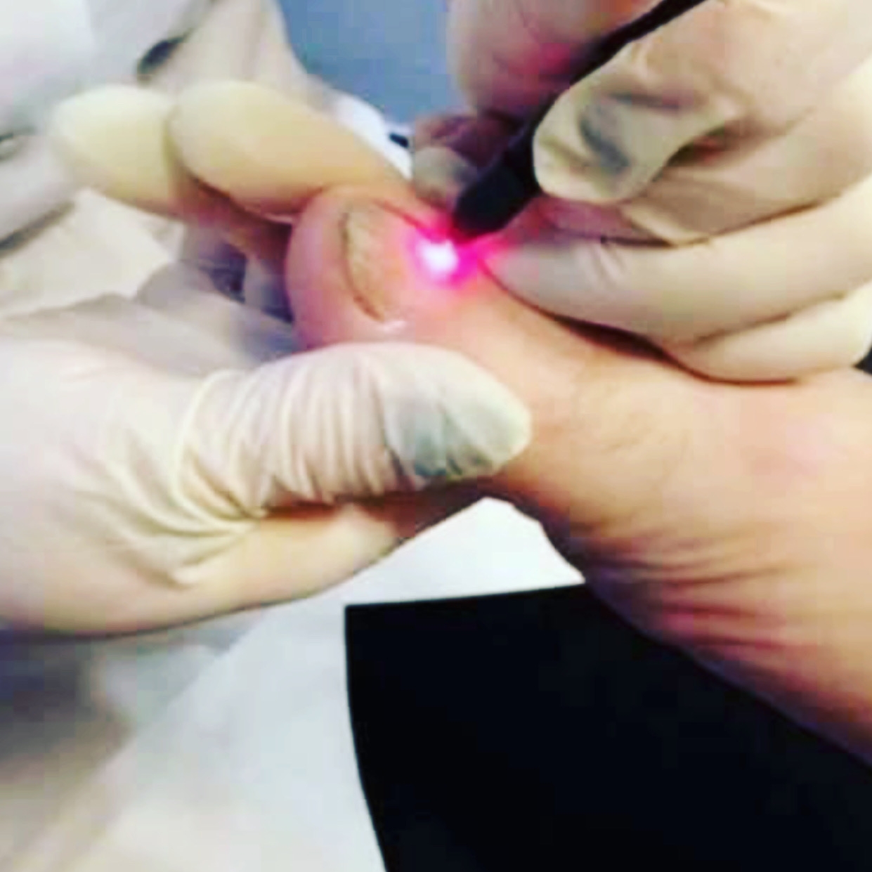 Schimmel-en Kalknagels Laserbehandeling PinPointe | Knokke-Heist