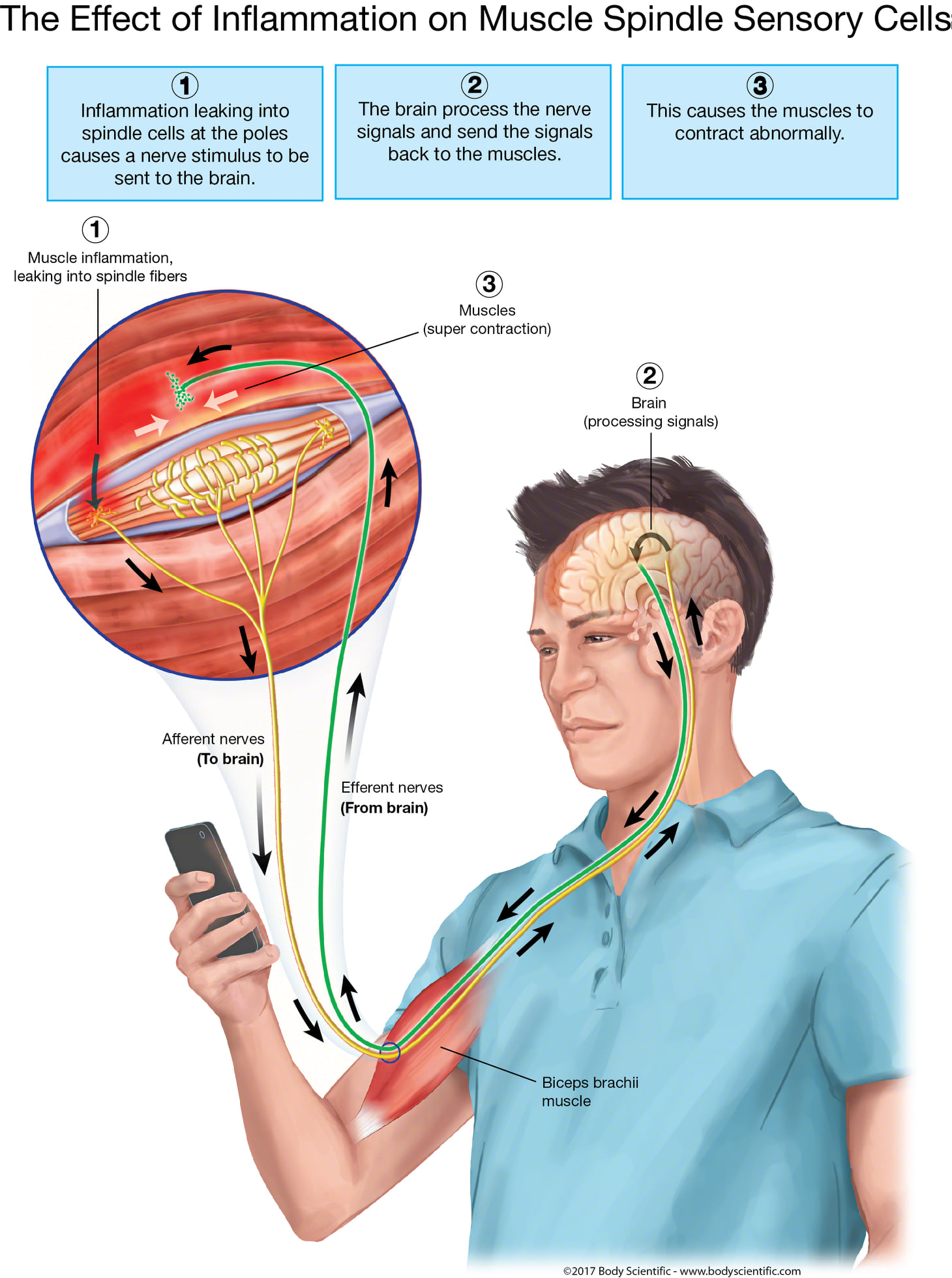 How... - The Human Spring Approach to Thoracic Outlet Syndrome | Facebook