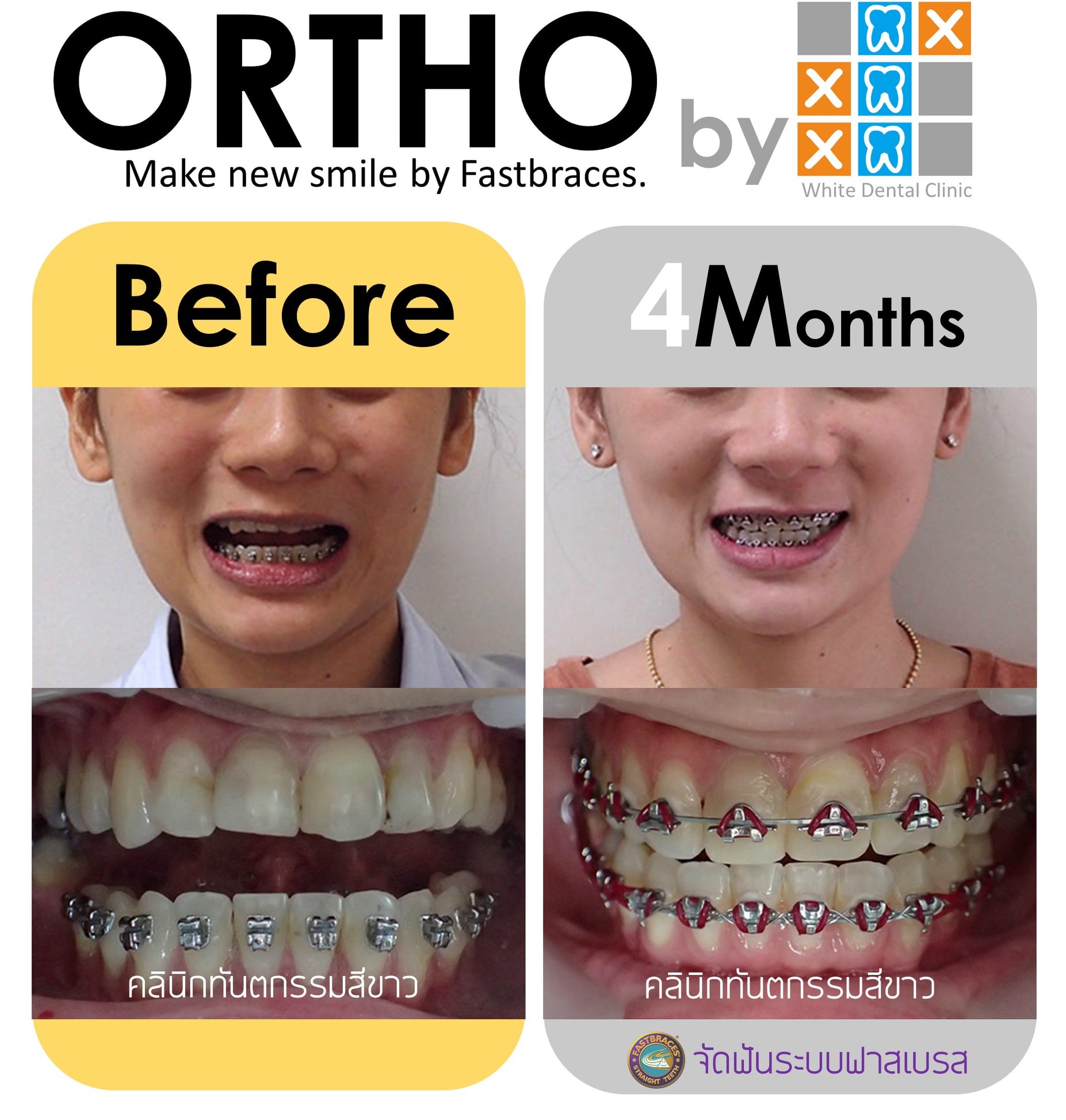 WDC | Fastbraces... - คลินิกทันตกรรมสีขาว | Facebook