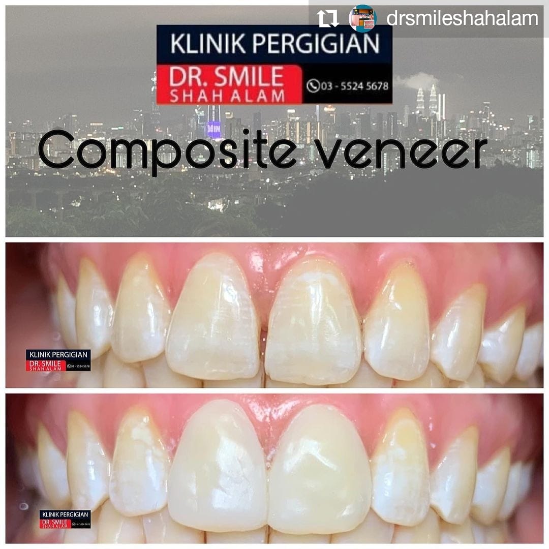 Klinik Pergigian Dr Smile Repost Drsmileshahalam Klinik Pergigian Dr Smile Shah Alam Hi Everyone Call Us For Booking 03 55245678 Compositeveneer Compositeveneermurahshahalam Klinikpergigiandrsmileshahalam