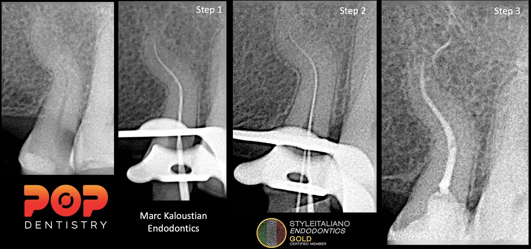 Endodontic Treatment with Glide Path Files for Curved Canals
