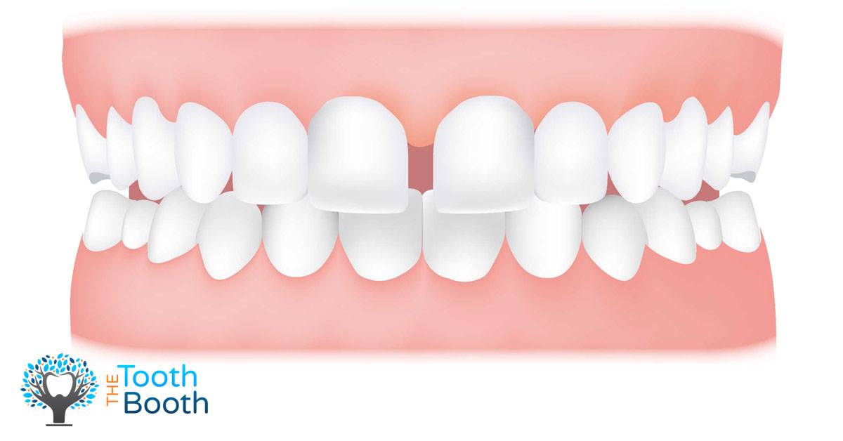 Tooth Booth. - Diastema (Gap Between Teeth) What Is It?...