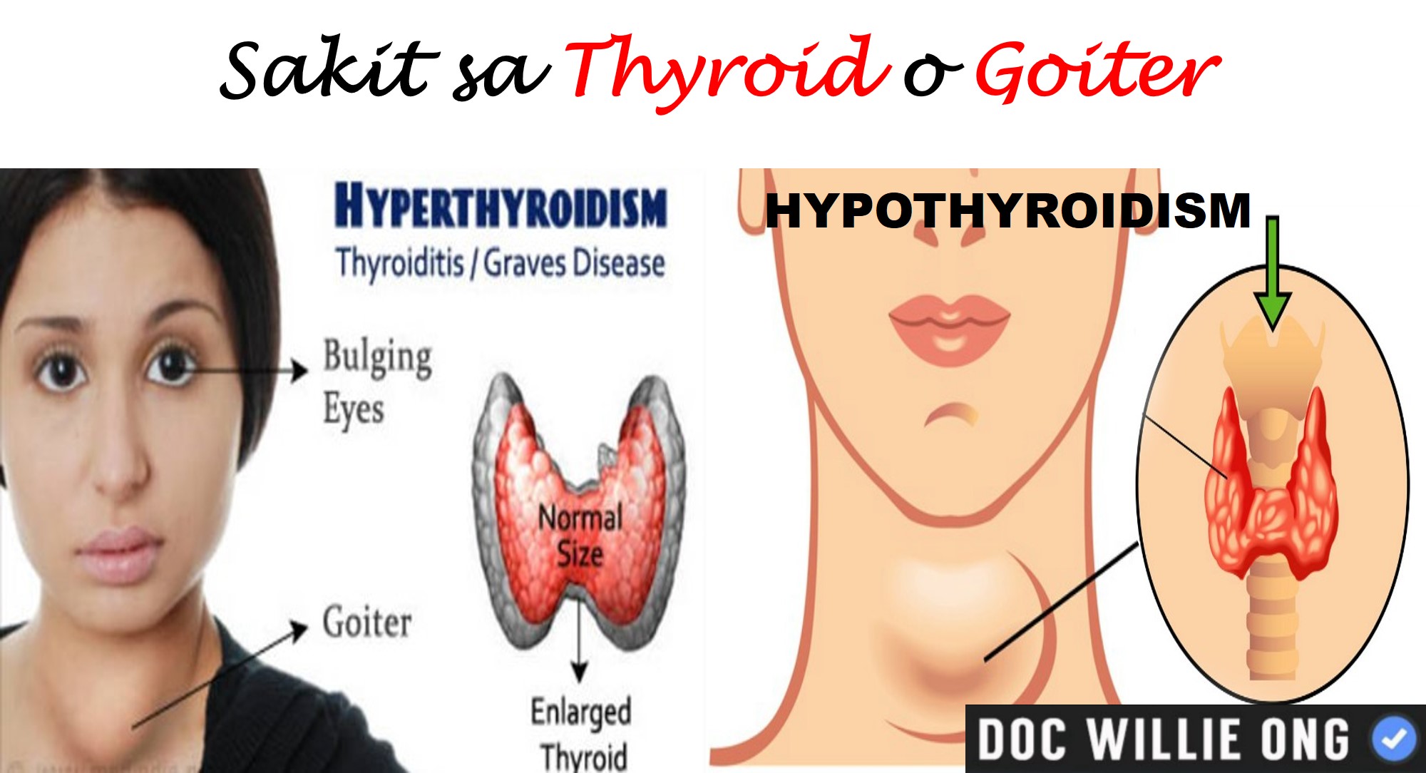 Doc Willie Ong - Sakit sa Thyroid o Goiter Ni Dr. Willie...