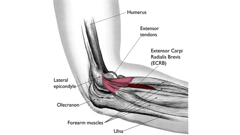 York-Med Physiotherapy & Wellness Centre - Tennis elbow or lateral ...