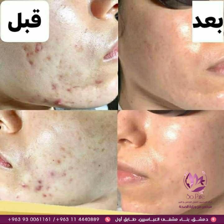 ميزوثيرابي مع ديرما مركز العباسيين الطبي للتجميل والليزر Facebook