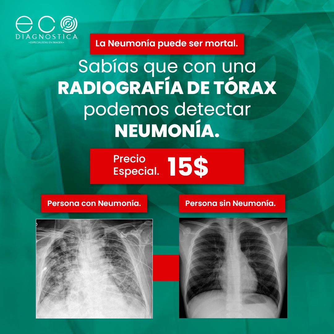 Ecodiagnostica - 🤒🌬️La neumonía es una inflamación aguda...