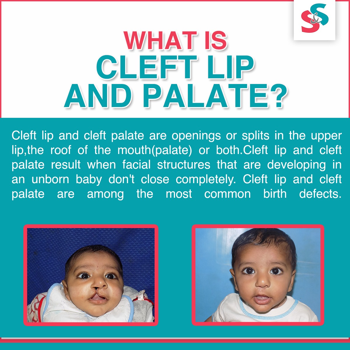 SmileandSpeak - What is a Cleft Lip or Palate? Cleft lip and cleft ...