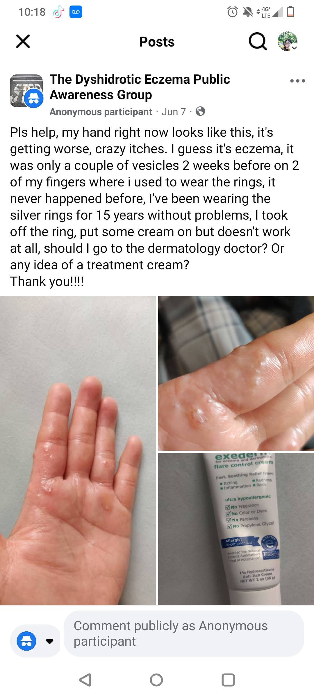 Anyone else here on tirzepatide? Ever since I have been taking it and losing weight along with going to the gym 5 days a week, my hands have been completely clear despite