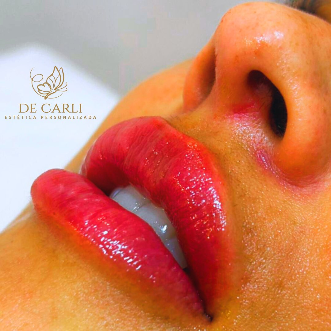 Estetica - 💋 Nossa técnica de preenchimento labial com 1 ml de ácido ...