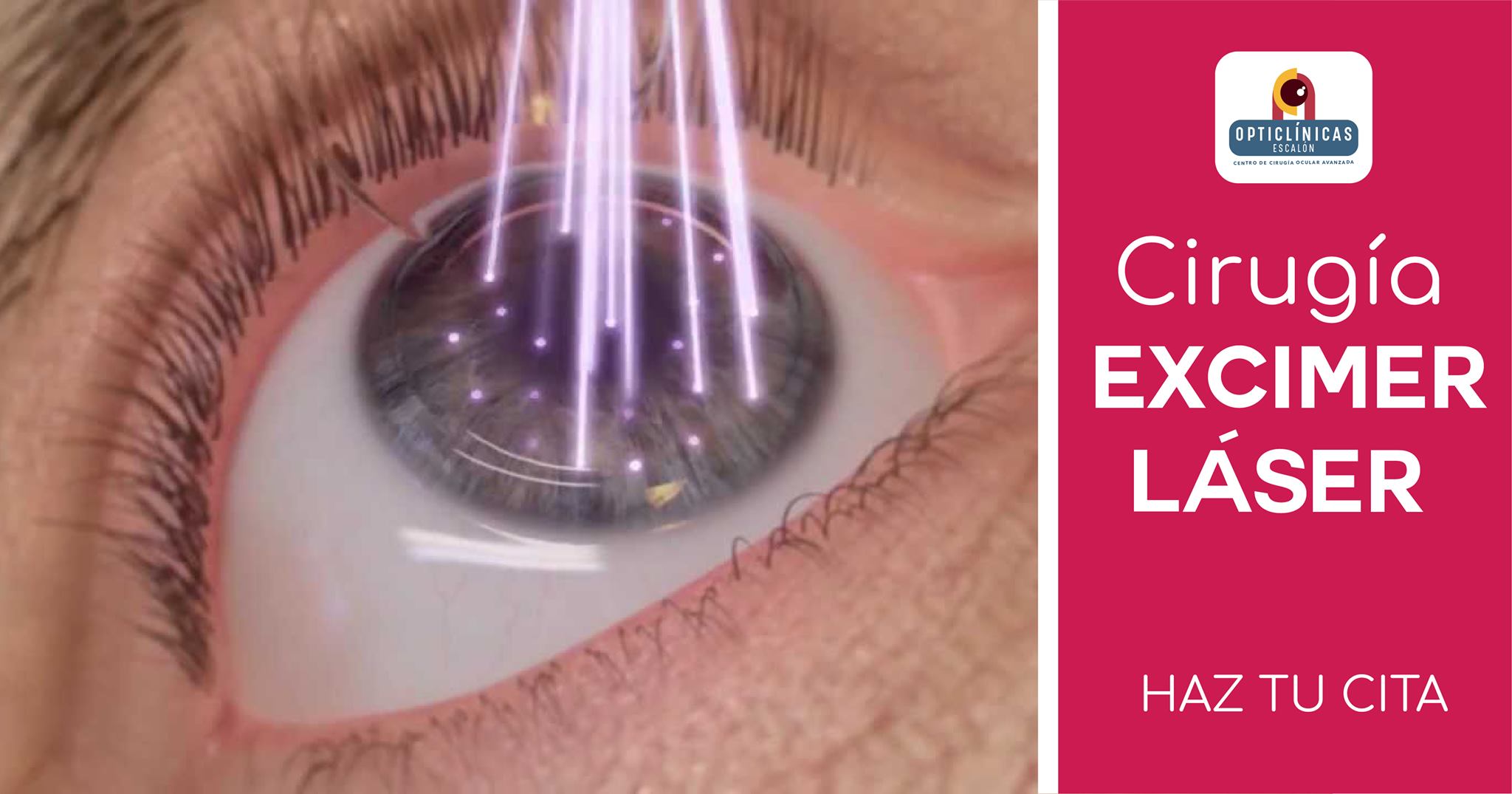 Opticlinicas - La cirugía Excimer Láser consiste en operar los defectos ...