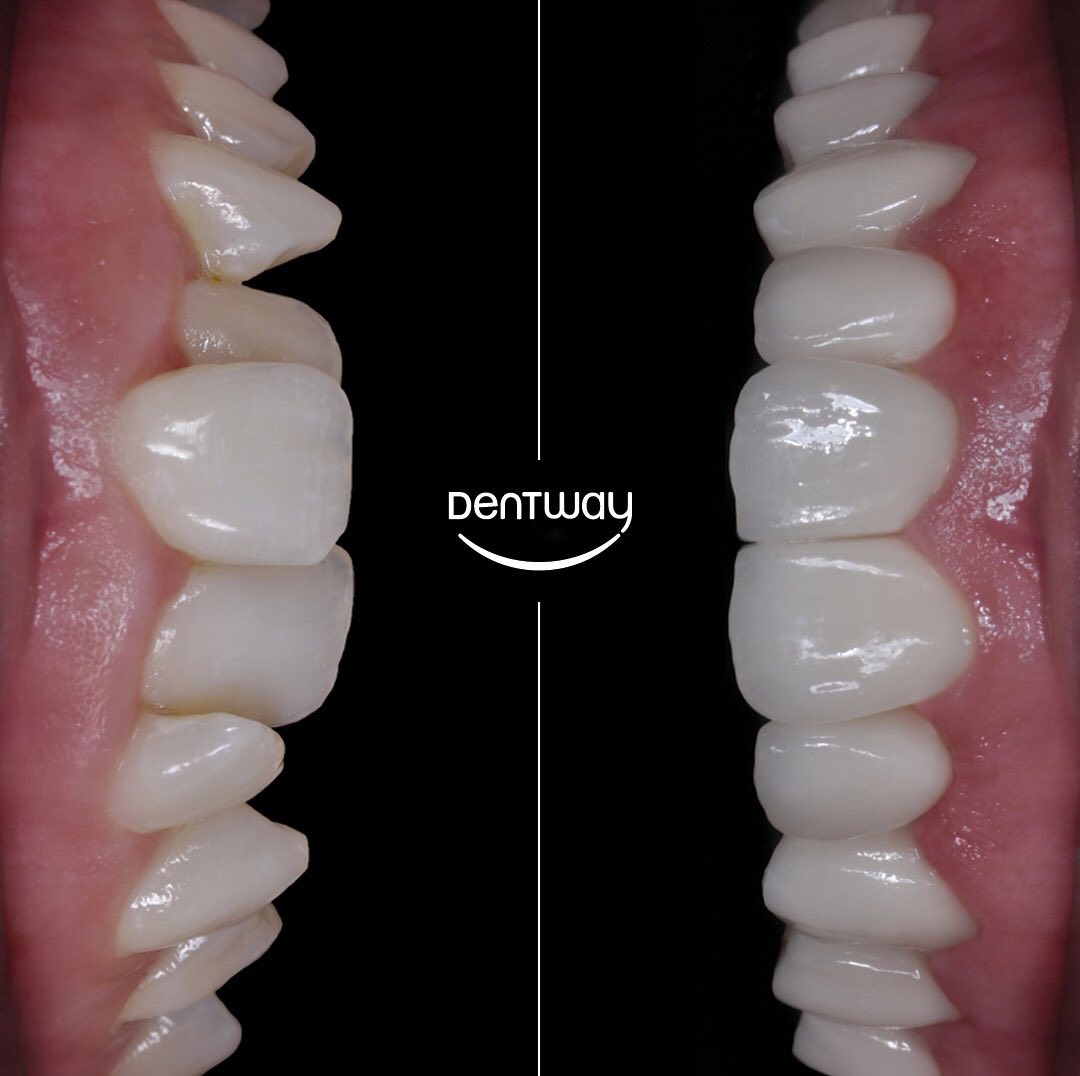 Dentway - In cases where the harmony between the teeth and gingiva is ...