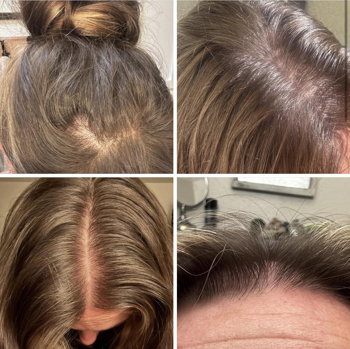 minoxidil vs ghk cu Which is better for hair growth, ghk-cu or minoxidil? Cyanocobalamin for Injection Size:1000 mcg/ml - 1 box (10amp. x 1ml) Mic B12 Injections Near