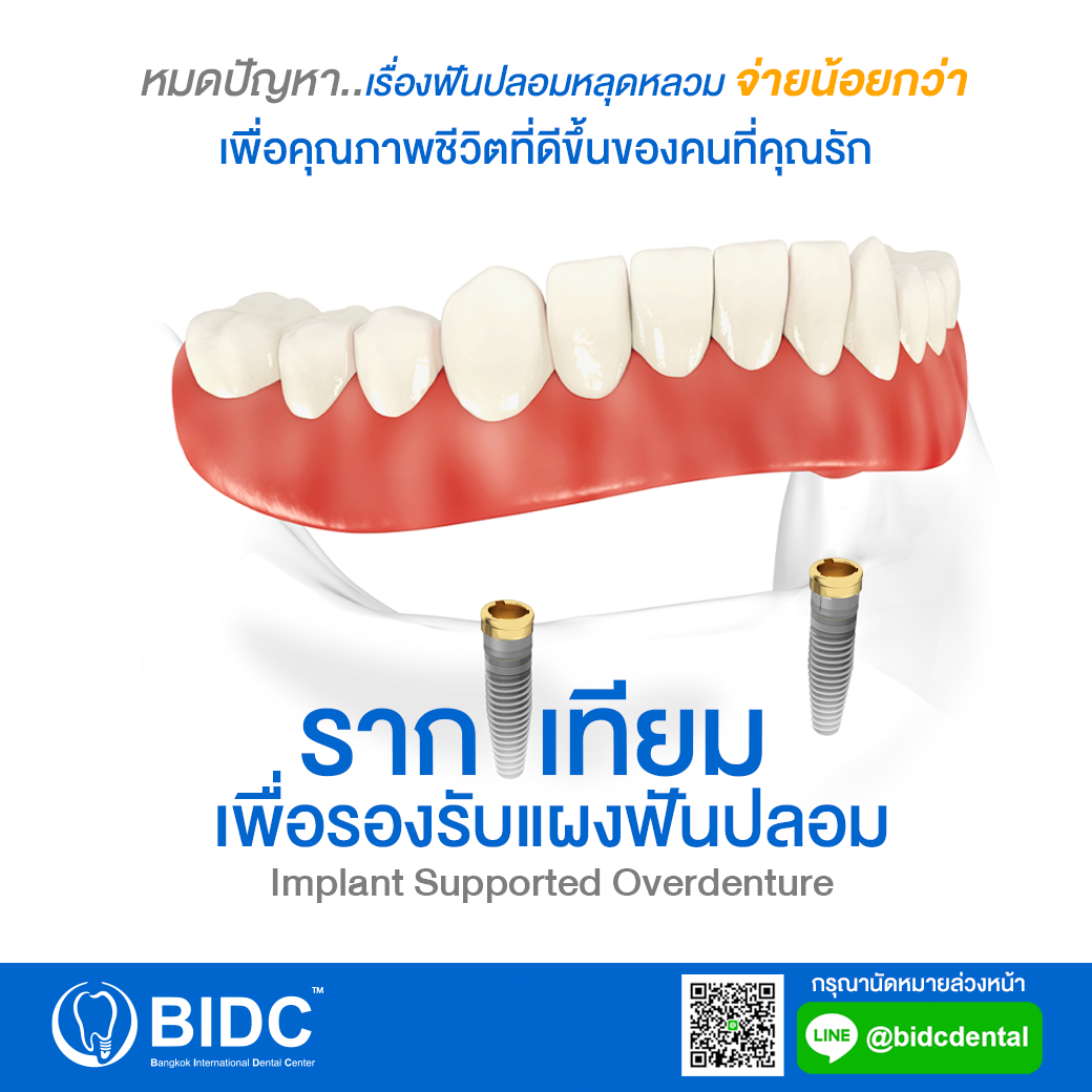 รากเทียมเพื่อรองรับแผงฟันปลอม (Implant supported overdenture) 🦷 หมด ...