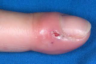 What can be used to treat whitlow on a child's hand?