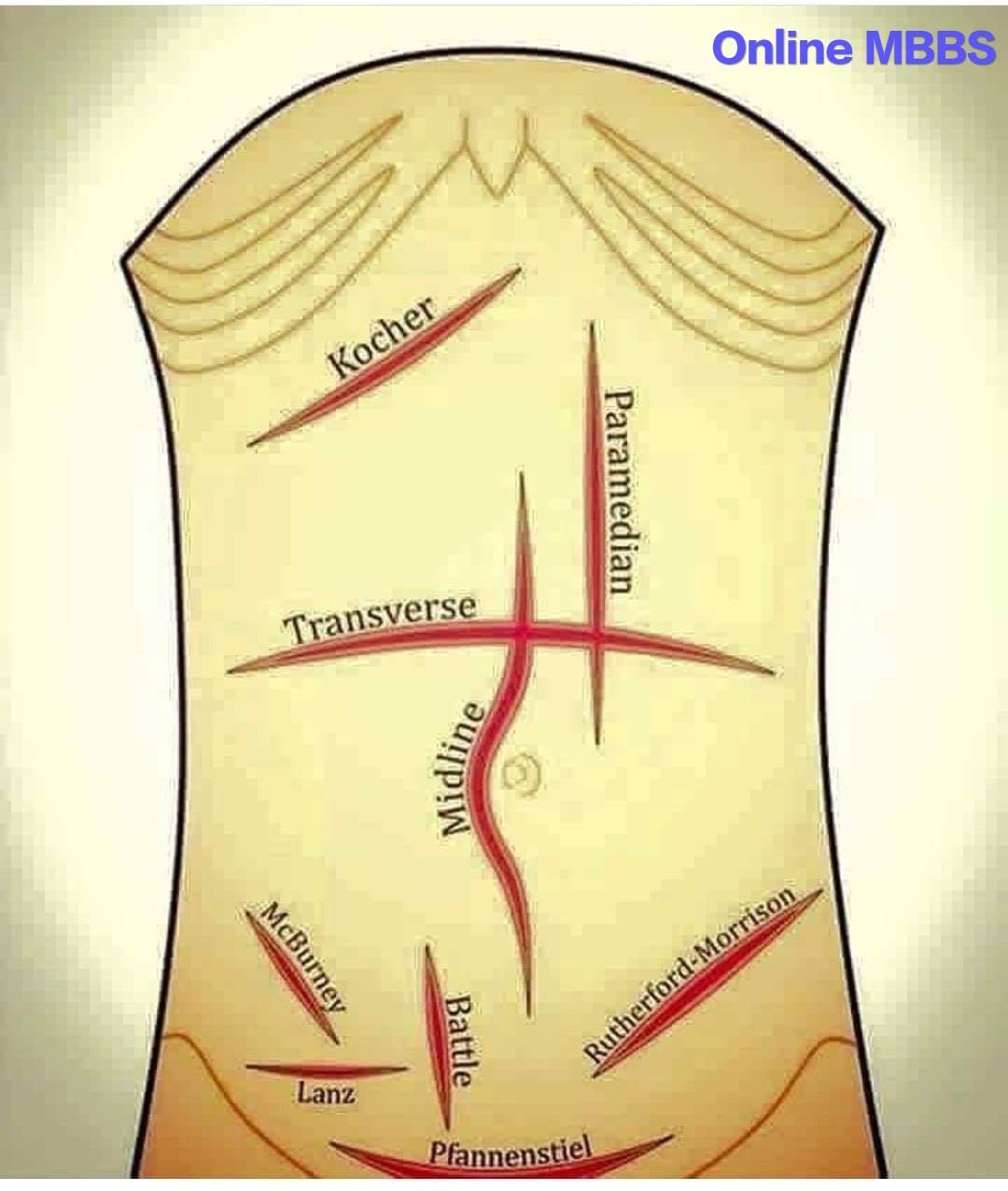 Online MBBS - Types of surgical incisions and their...