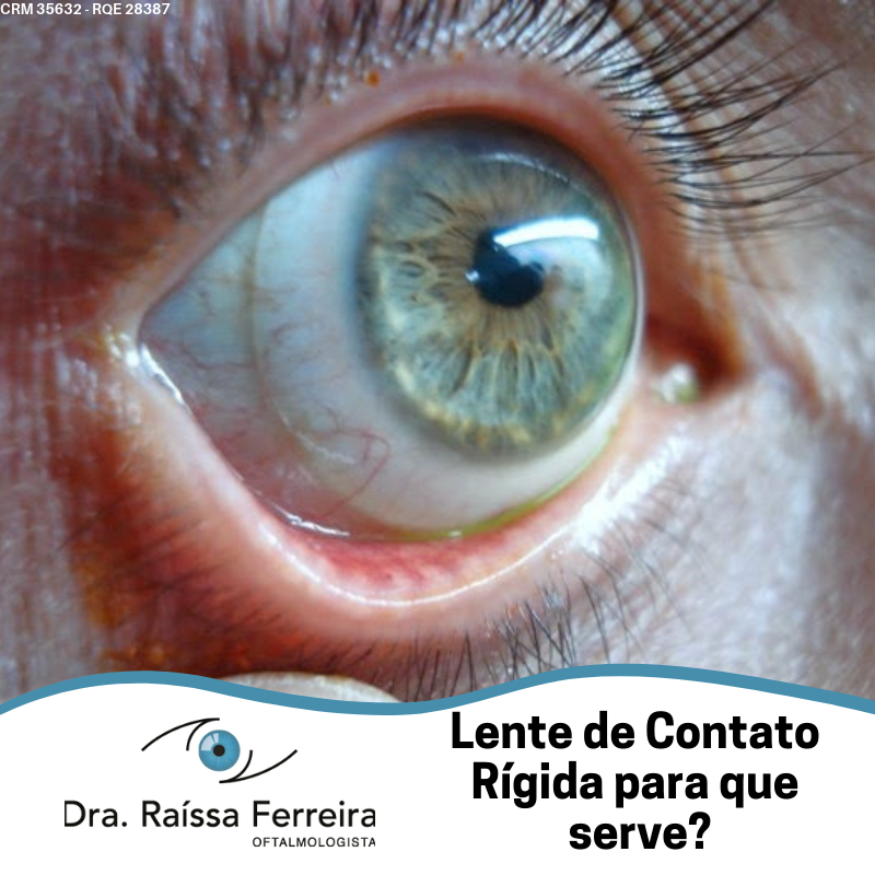 A Lente de Contato Rígida (LCR),... - Dra. Raissa Ferreira | Facebook