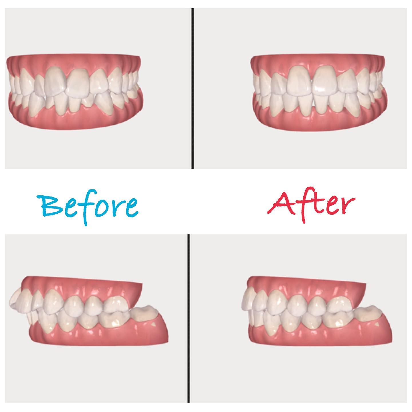 iTero Scanner: Invisalign Outcome... - Pacific Dental Care