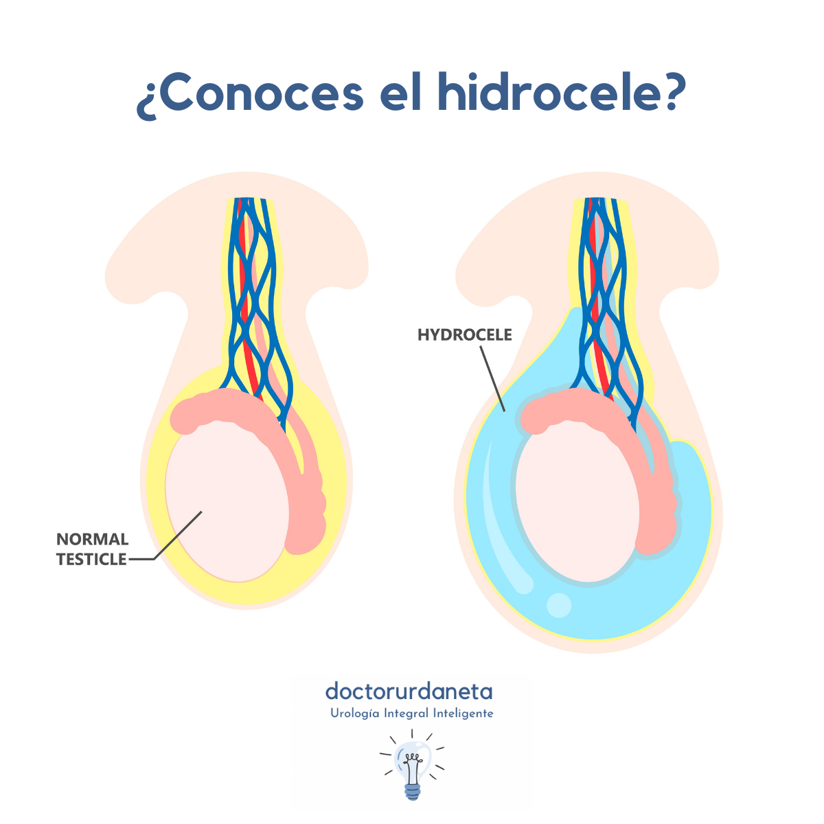 doctorurdaneta - ¿Conoces el hidrocele? Un hidrocele es un... | Facebook