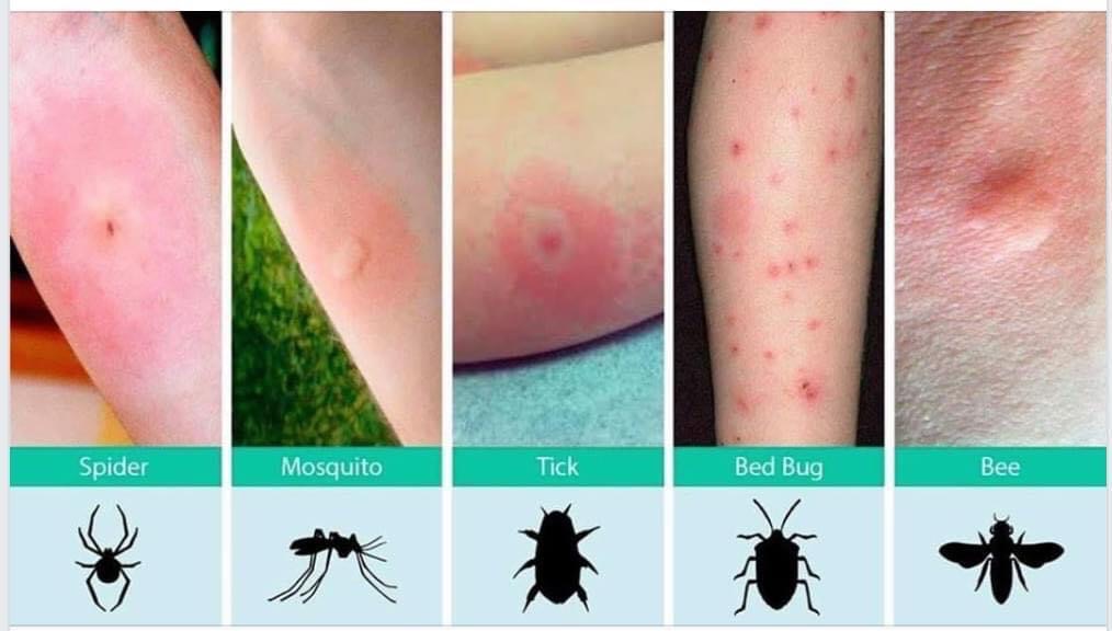 Tick Bite Rash Pictures Humans