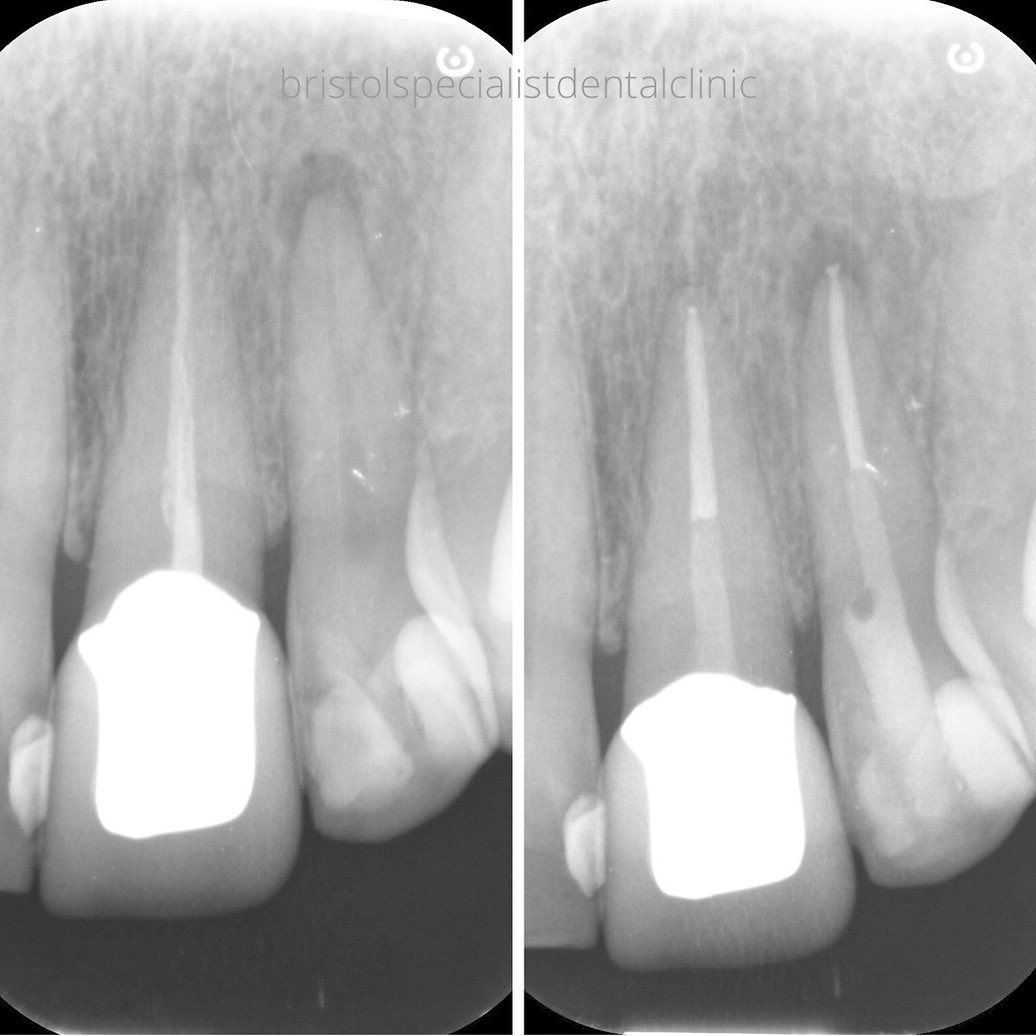 Bristol - Pre and post operative radiographs of two incisors. #rct Call ...