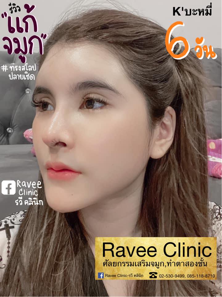 Ravee Clinic - รวี คลินิก - แก้จมูก👃🏻