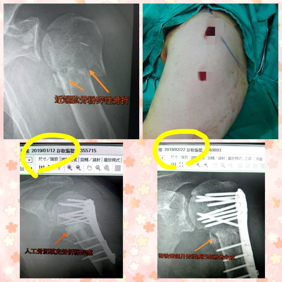 微創人工骨泥注射 手腕遠端橈骨粉碎性骨折 肩膀近端肱骨粉碎性骨折 桃園 骨折微創 脊椎微創手術李龍興醫師 Facebook