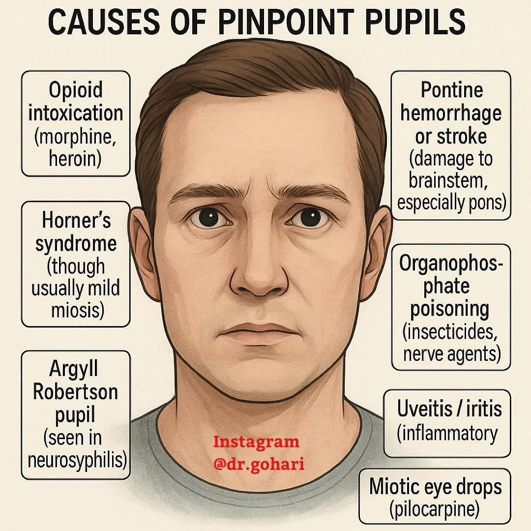 Mohammad - Causes of pinpoint pupil...... #خواطرمن الطوارئ | Facebook