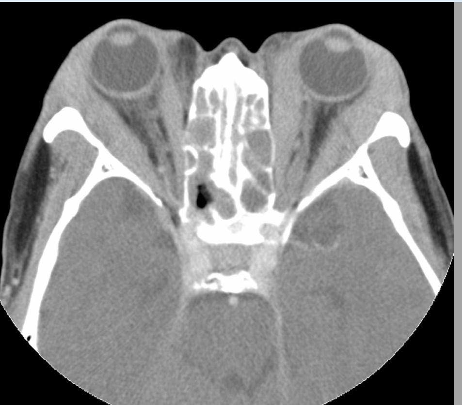 A patient came to OPD with painful proptosis of the left eye. On MRI ...
