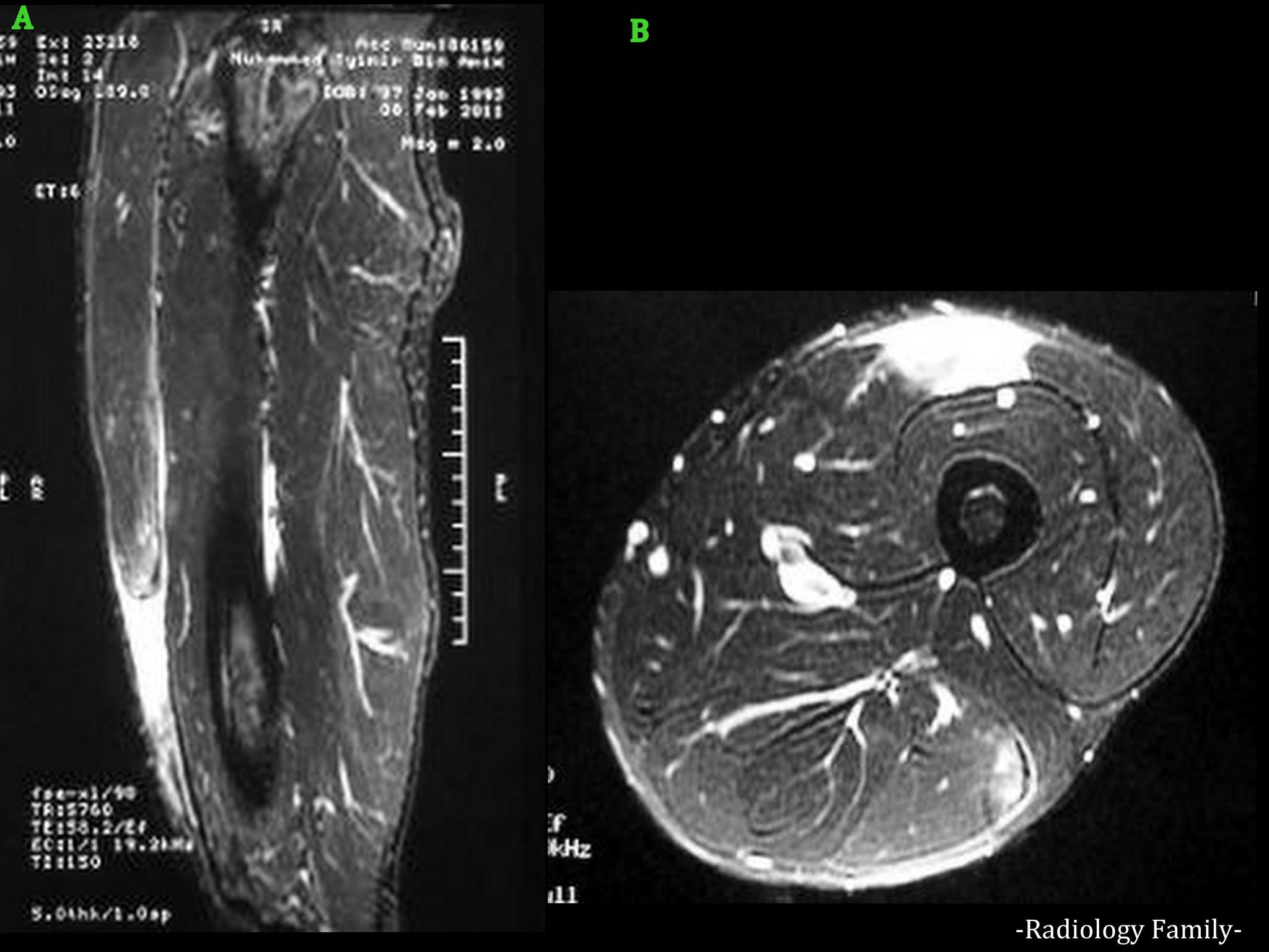 Radiology Family - Rectus Femoris Tendon Rupture. A rectus femoris ...
