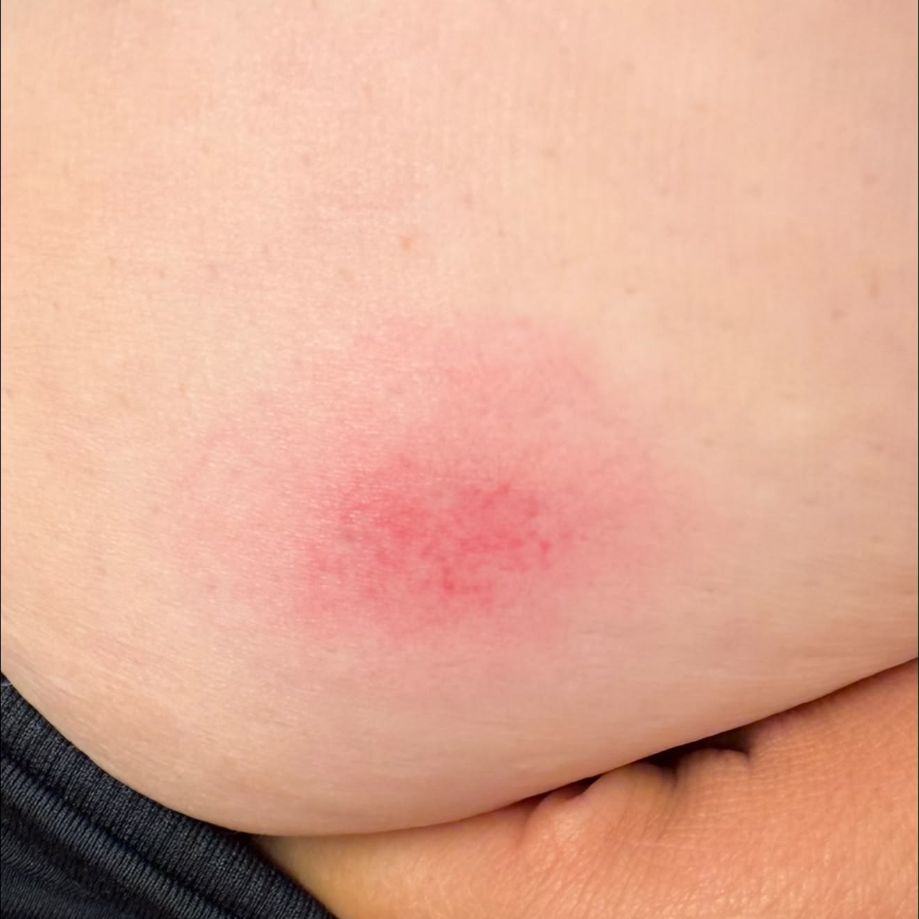 klow sting Starting taking 2 days ago. The morning after my first injection, I had a slight pain by the injection area. Nothing crazy and it went away after a hour or two Amount:50μg vitalstoffe BPC-157 5 mg y