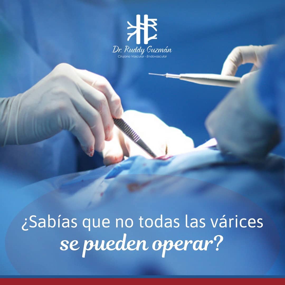 Dr. Ruddy Guzman - Primero debes saber que existen dos tipos de várices ...