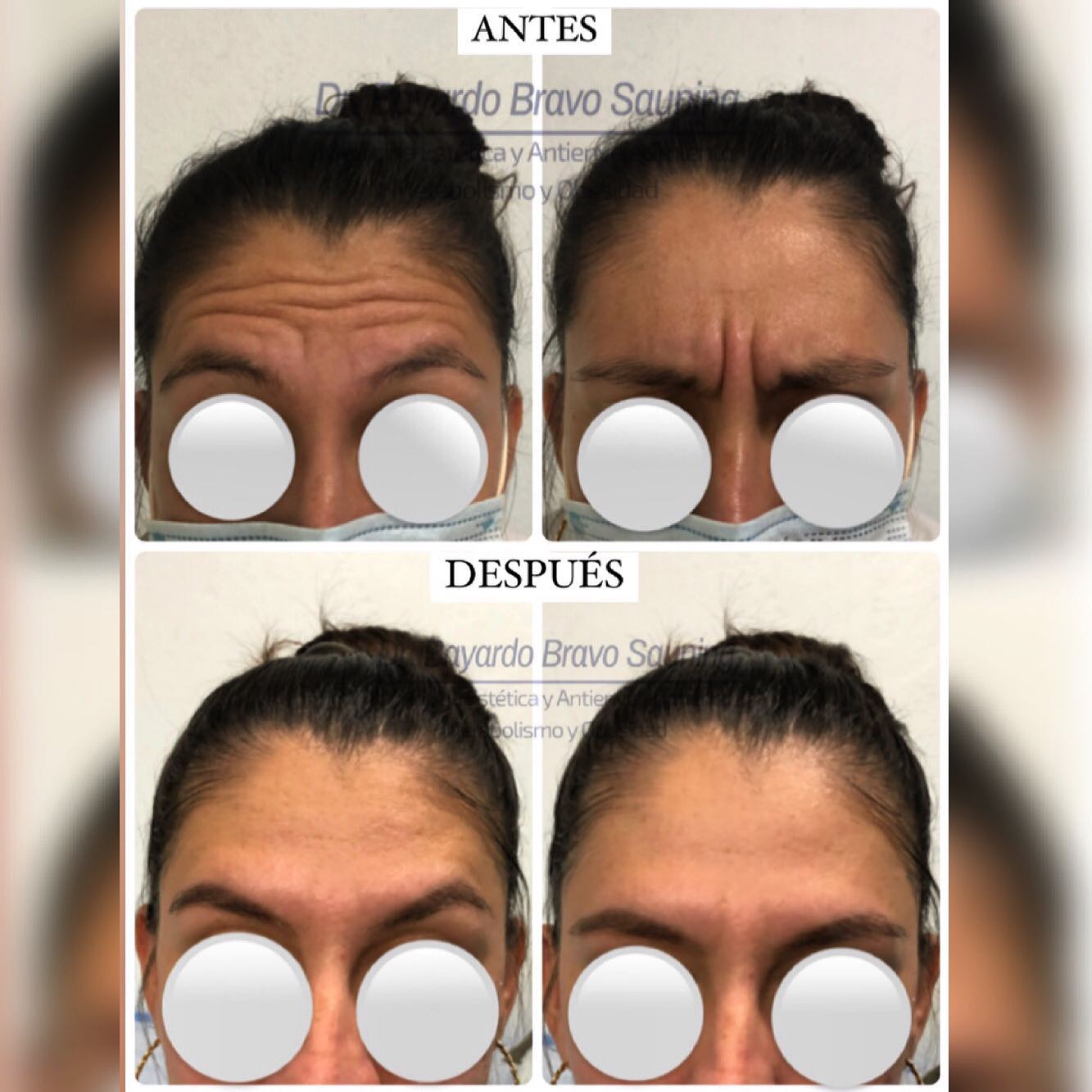Tratamiento para prevenir y atenuar líneas de expresión del entrecejo y ...