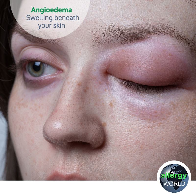 QUICK MEDICAL EXPLANATION: What this lady has is called “angioedema”. It is a form of allergic reaction. This is the medical term for the sudden development of seemingly unexplained face swelling on