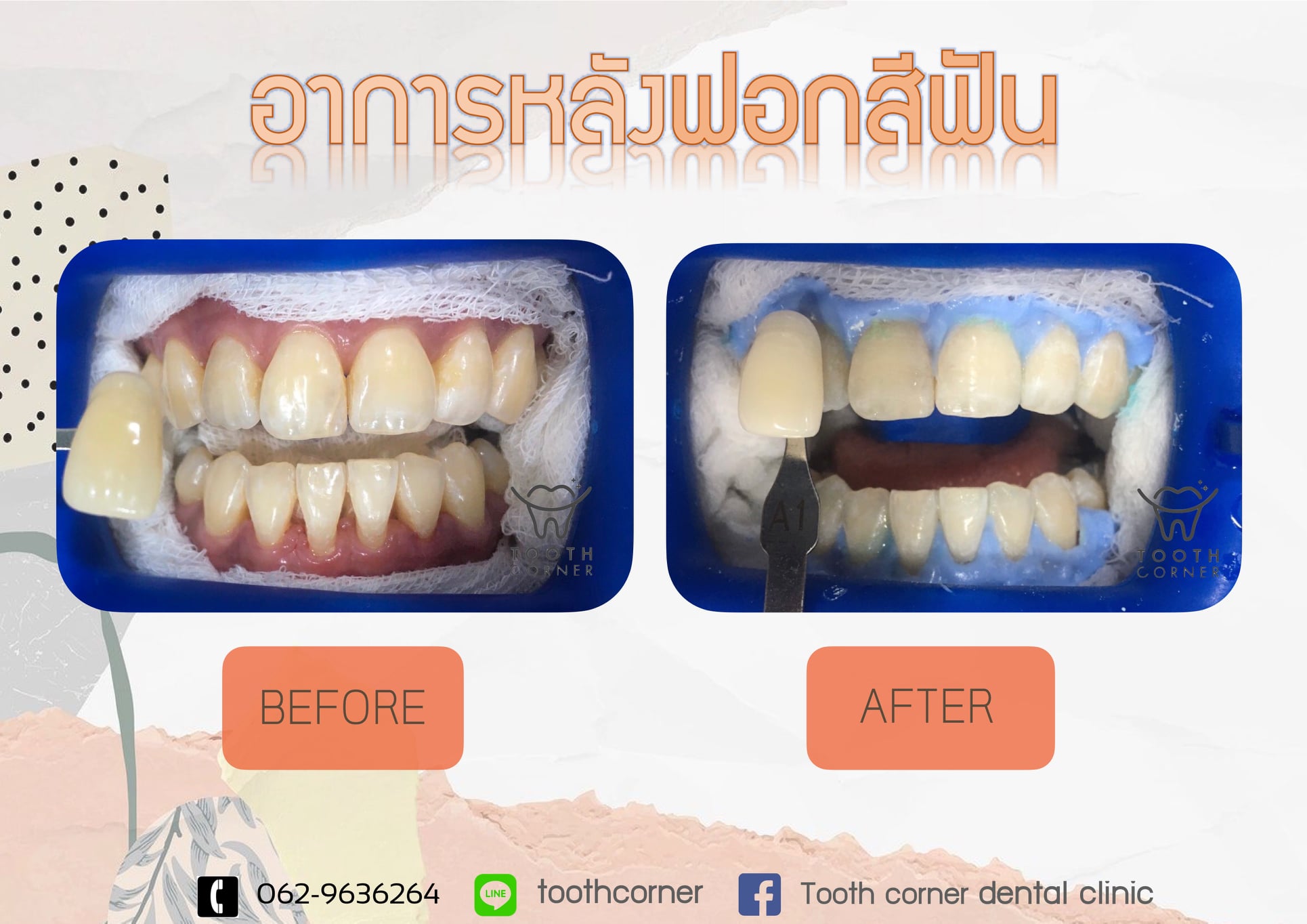 สว... - Tooth Corner Dental Clinic - คลินิกทันตกรรมทูธคอร์เนอะ