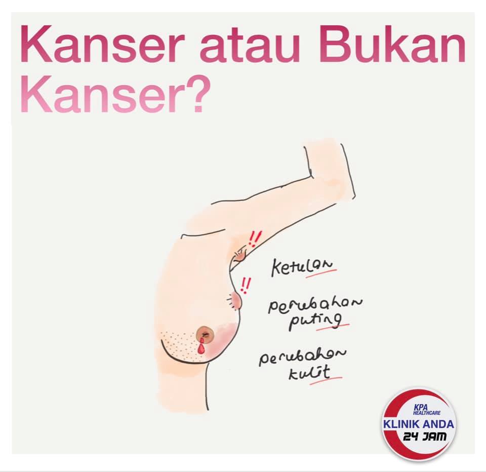 Klinik Anda Serdang 24 Jam Bersama Doktor Anda Ketulan Paudara Bahagian 2 Ok Hari Ini Kita Bercerita Tentang Ketulan Payudara Yang Lebih Merisaukan Barah Payudara Fakta Pantas Barah Payudara