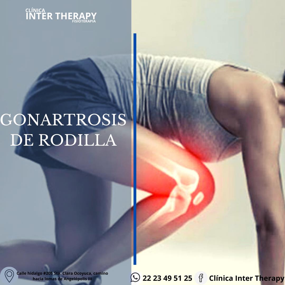 La GONARTROSIS es un desgaste... - Clínica Inter Therapy | Facebook