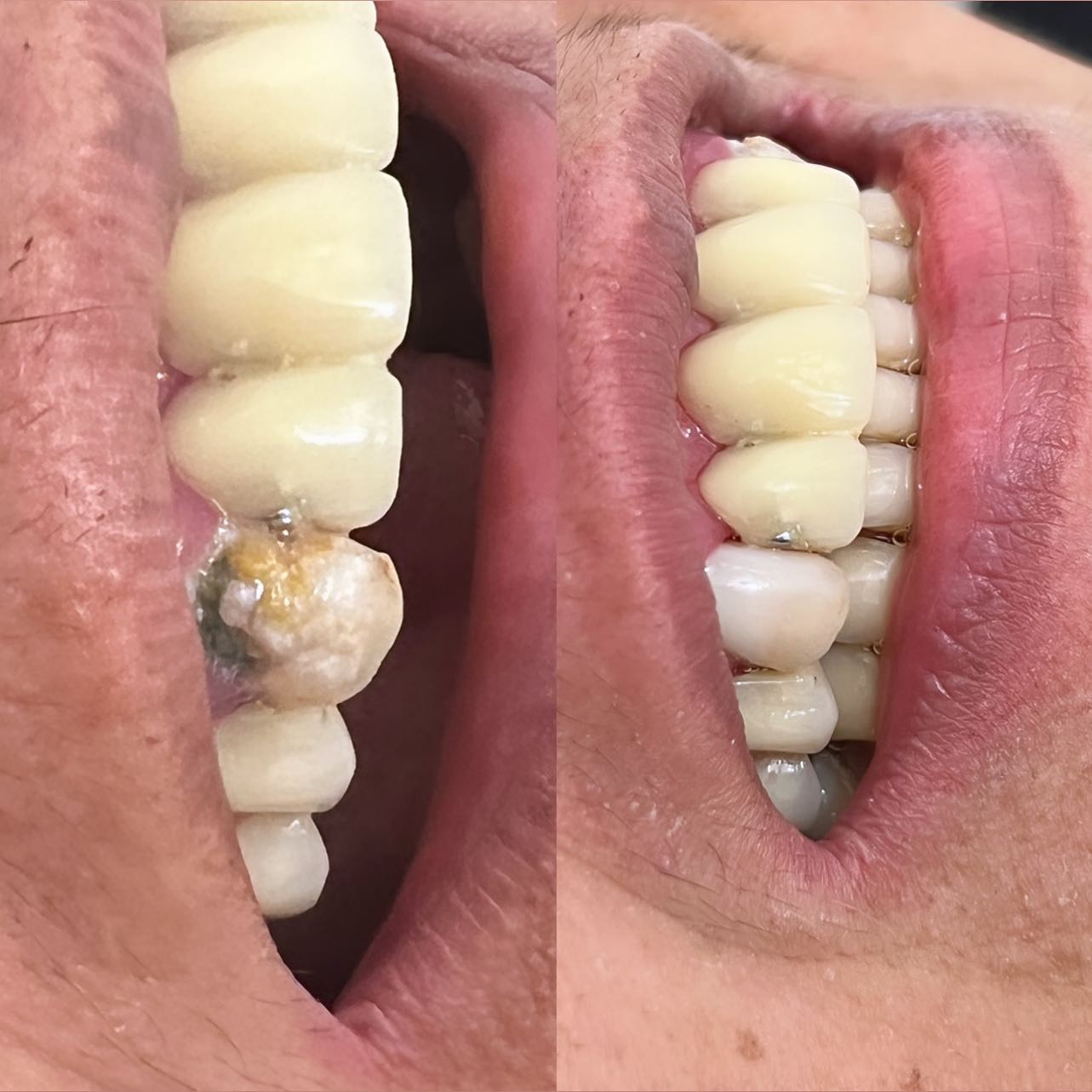 Dra. Karla Odontologia - Dente com toda face vestibular cariada ...