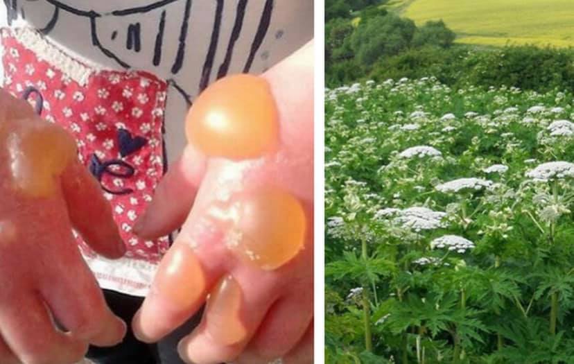 This is Giant Hogweed and this is what it can do! The Symptoms of ...