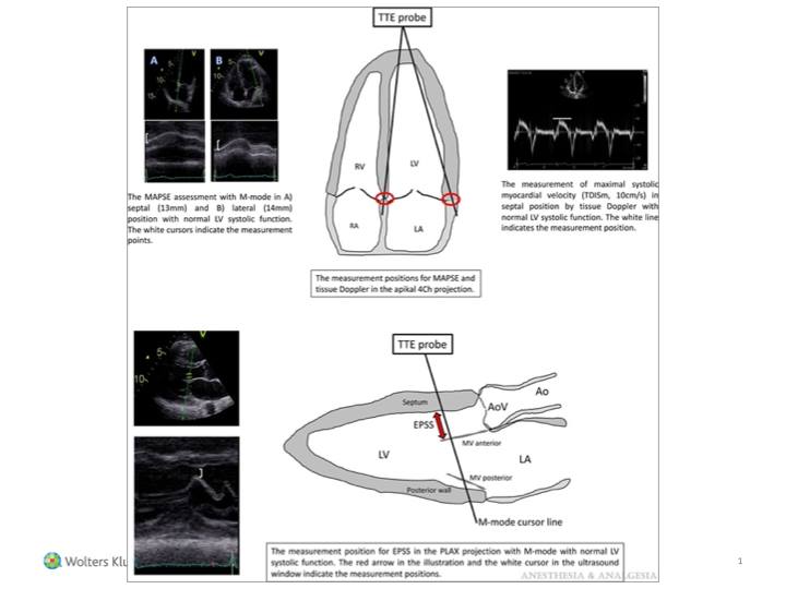 Anesthesia & Analgesia - 🔴 In a single center analysis of 3 point-of ...
